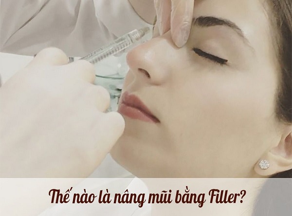 nâng mũi bằng filler