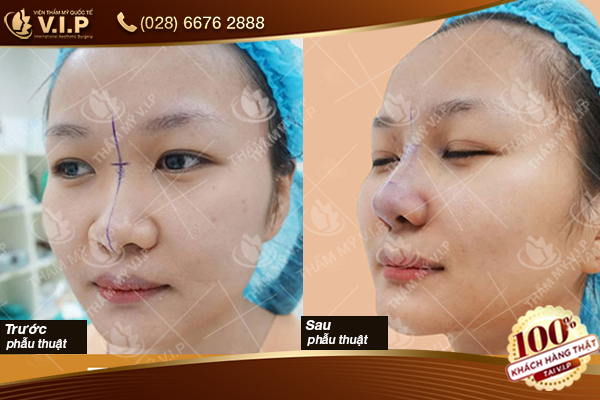nâng mũi s line ở đâu đẹp tphcm