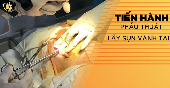 tiến hành nâng mũi bọc sụn s line