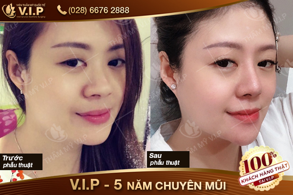 khách hàng nâng mũi bọc sụn s line