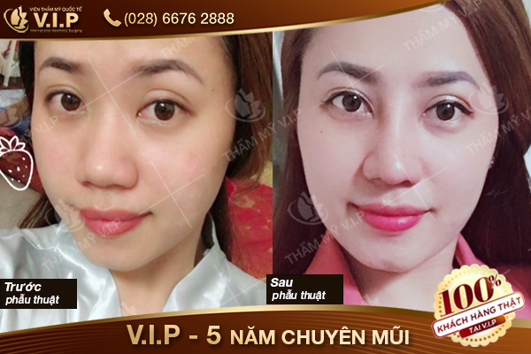 hình ảnh khách hàng nâng mũi bọc sụn s line