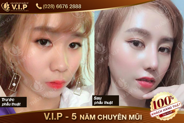 Ảnh khách hàng nâng mũi bọc sụn s line