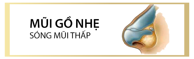 mũi gồ nhẹ