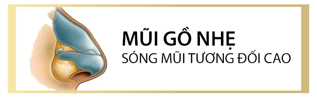 sửa mũi gồ