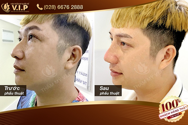 chỉnh sửa mũi gồ