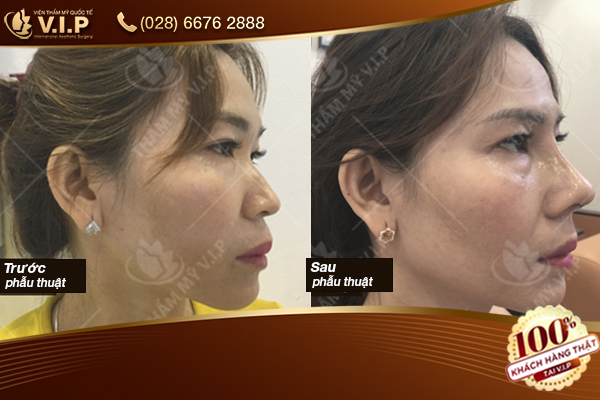chỉnh sửa mũi gồ