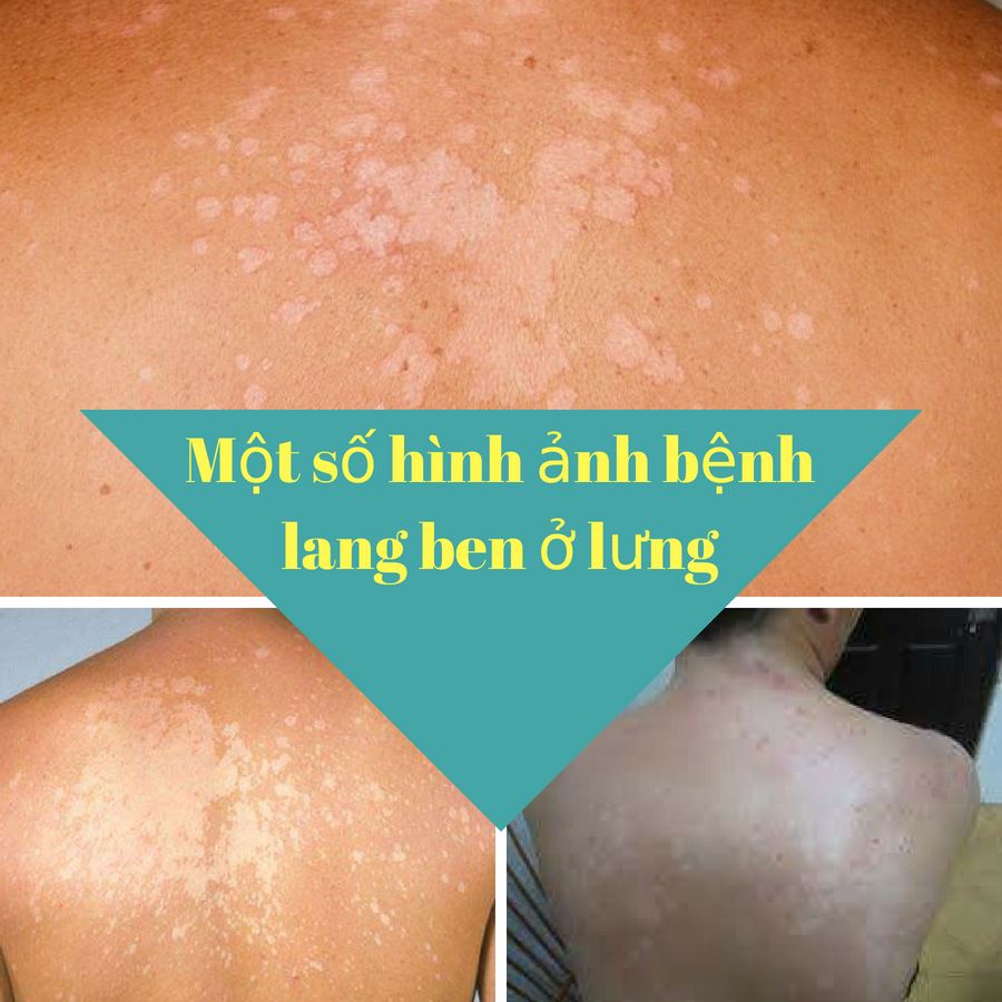 lang beng ở lưng