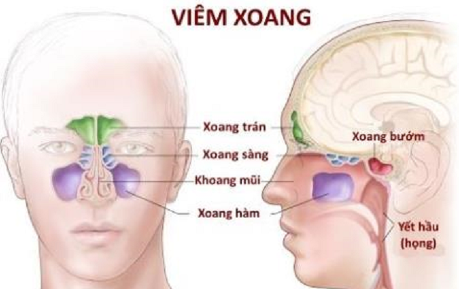 nguyên nhân bị viêm xoang