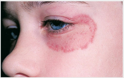 hình ảnh lác đồng tiền ở mặt