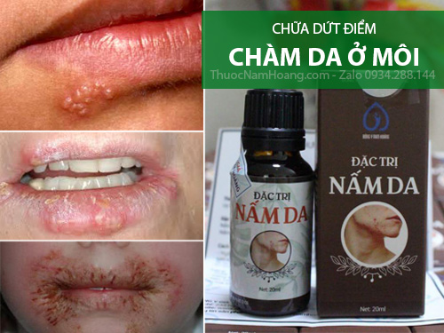 cách trị chàm tổ đỉa