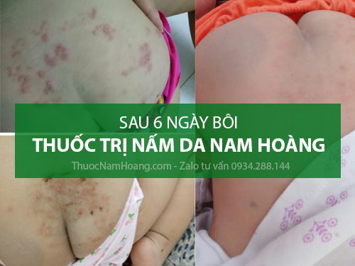 nguyên nhân bệnh chàm tổ đỉa