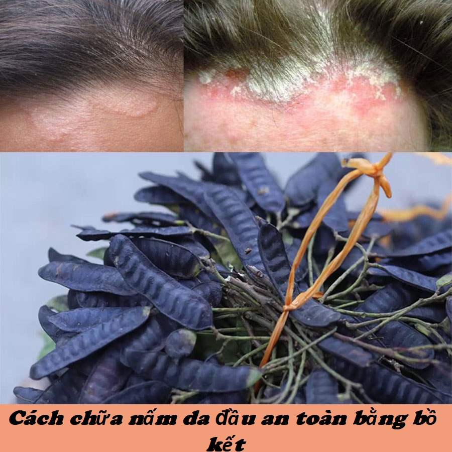 cách trị nấm da đầu bằng bồ kết