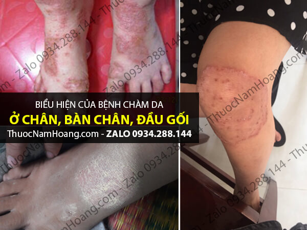 chàm khô đầu móng tay