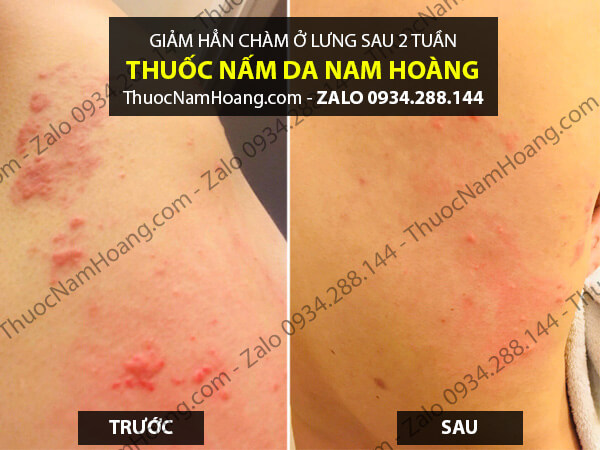 chàm nang lông