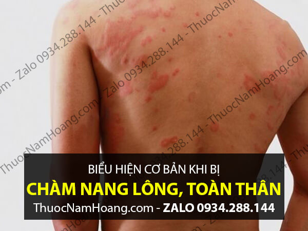 Cách chữa chàm nang lông