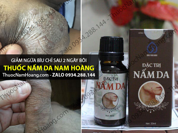 chàm bìu tinh hoàn