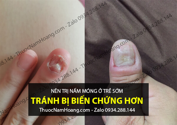bệnh nấm móng tay