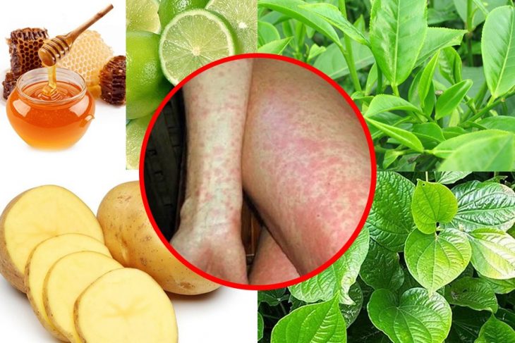 ngứa toàn thân bằng dân gian