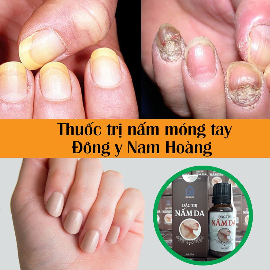 thuốc trị nấm móng tay chân