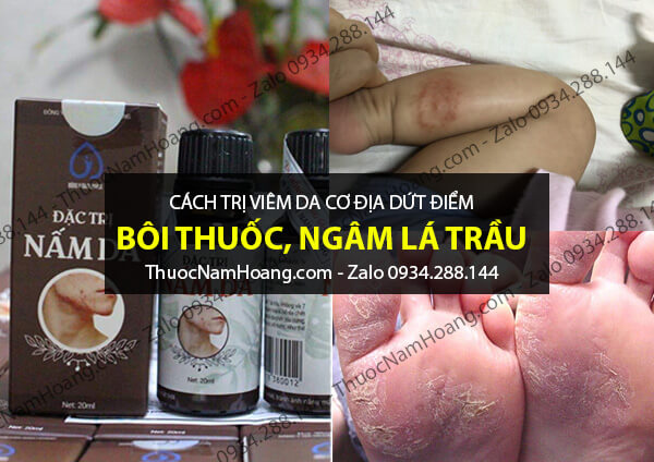 thuốc chữa viêm da cơ địa ở chân
