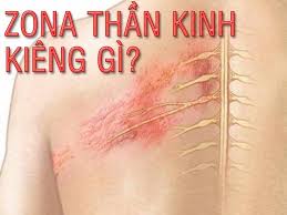 bệnh zona thần kinh