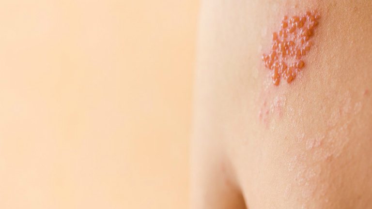 cách trị zona thần kinh