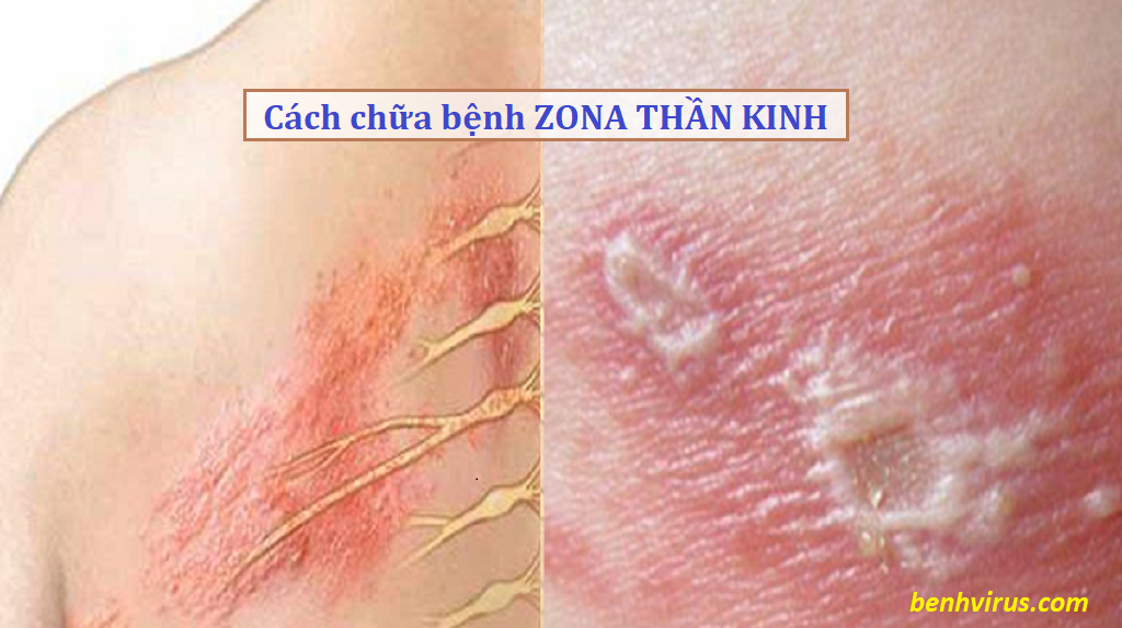 cách trị zona thần kinh
