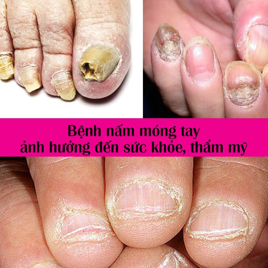 bệnh nấm móng tay có lây không