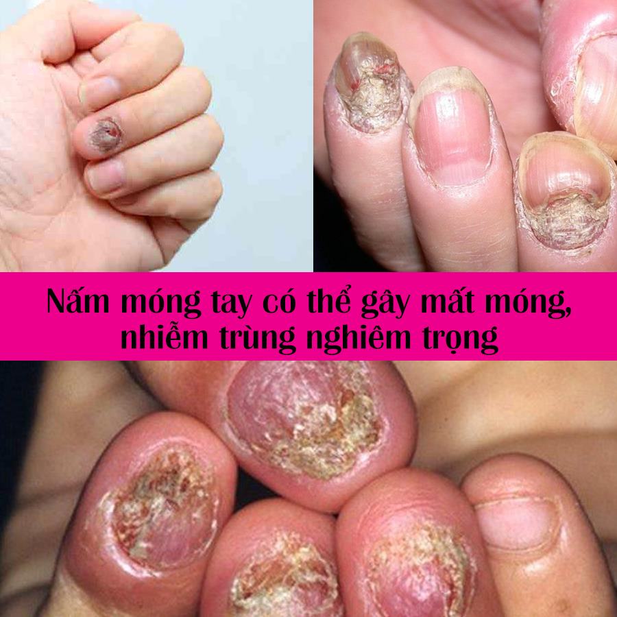 nấm móng tay chân