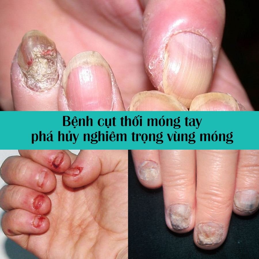 bệnh cụt thối móng tay