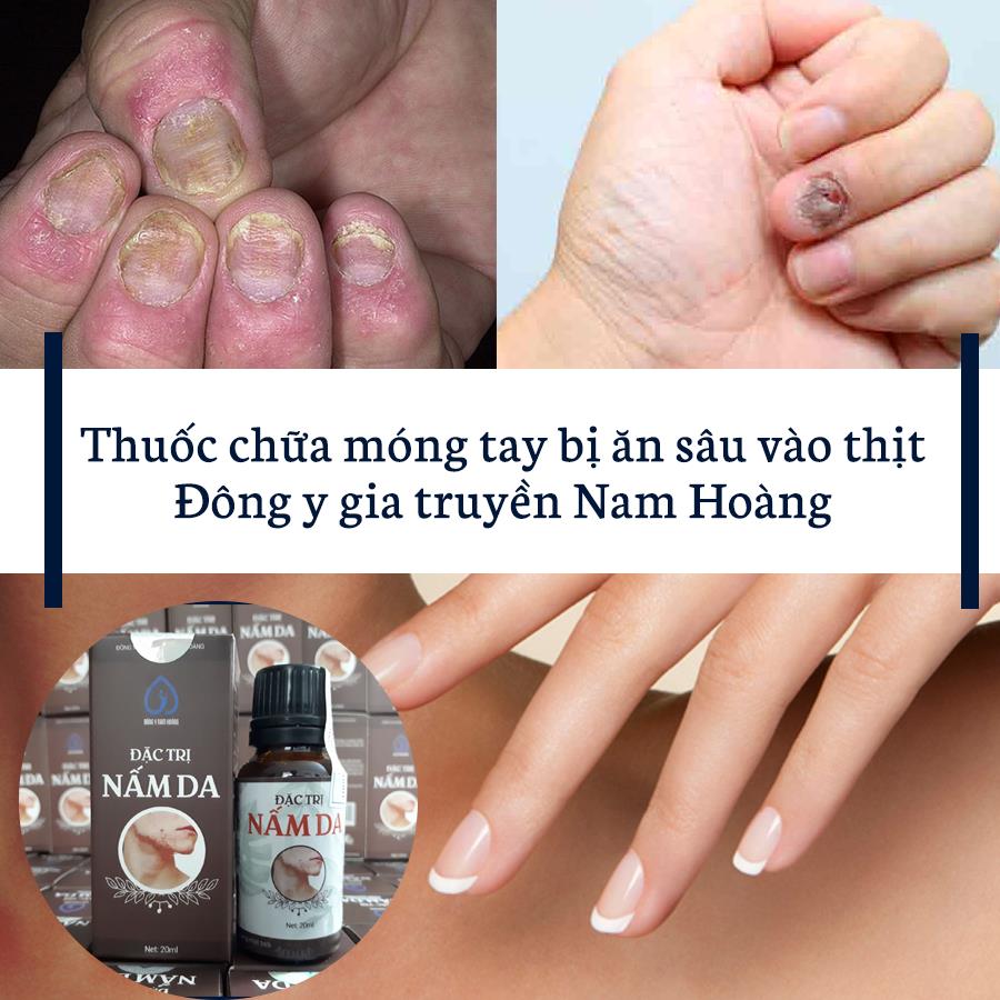 thuốc trị móng tay bị ăn sâu vào thịt