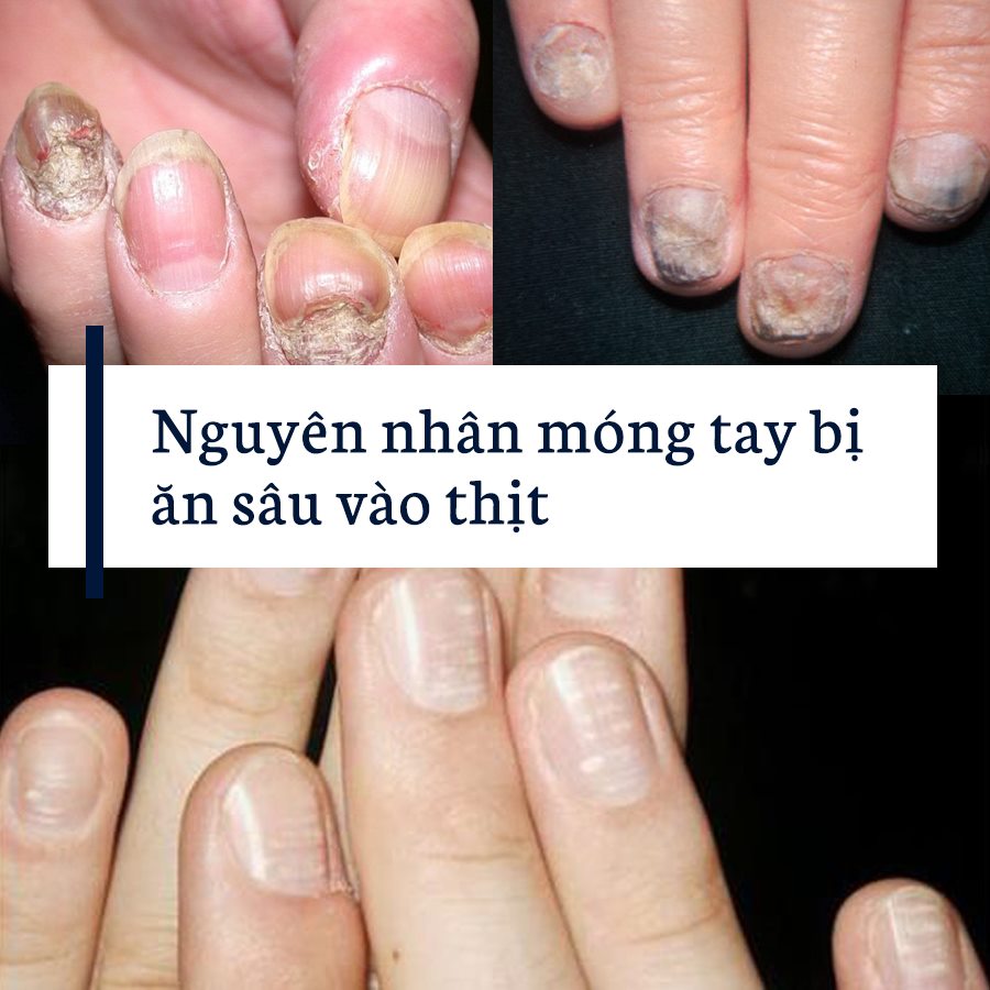 móng tay bị ăn sâu vào thịt