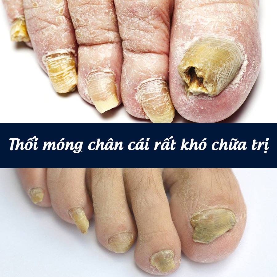 thối móng chân cái