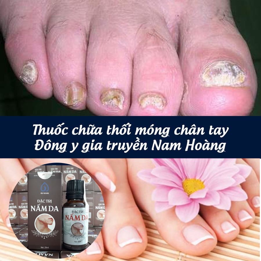 chữa thối móng chân cái bằng đông y