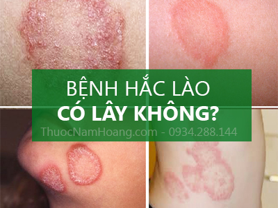 hắc lào có lây không