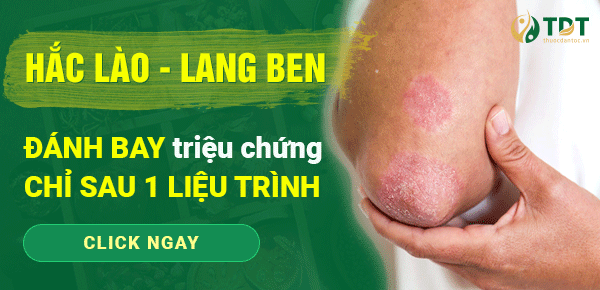 hắc lào ở tay chân