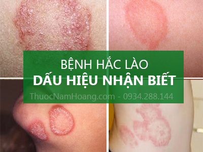trị hắc lào bằng chuối xanh