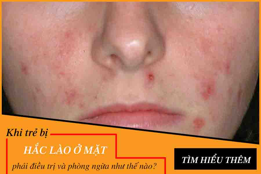 bị hắc lào trên mặt trẻ