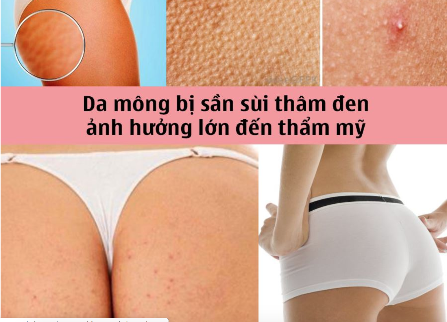 da mông sần sùi