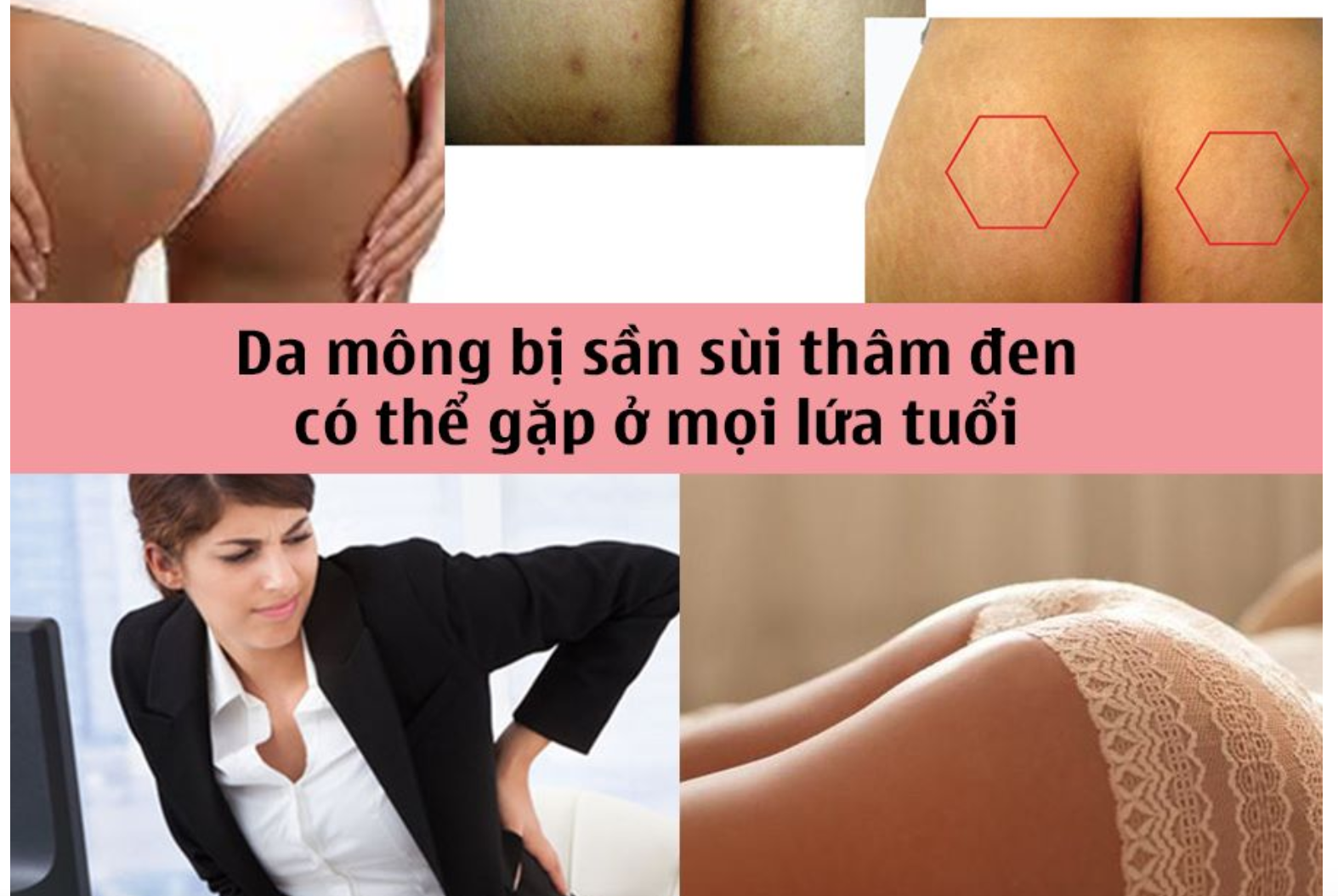 da mông bị thâm đen