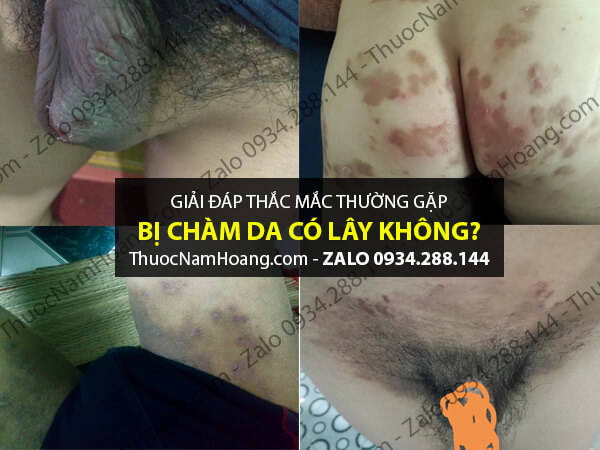 bệnh chàm bìu có lây không