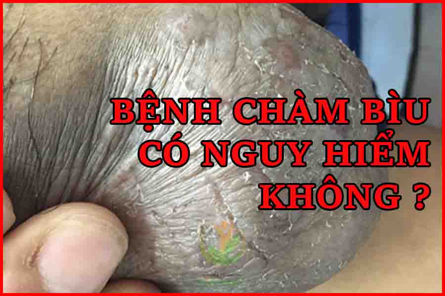 chàm bìu có nguy hiểm không