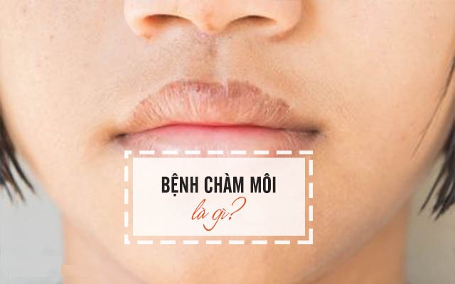 dấu hiệu của chàm môi