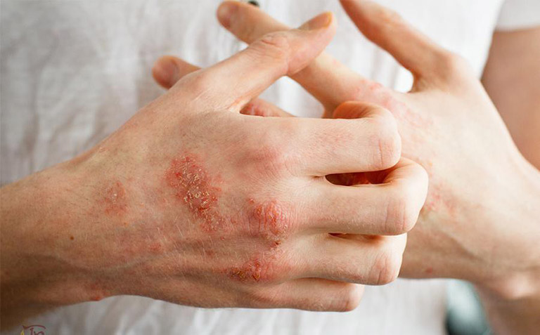 bệnh viêm da chàm hoá