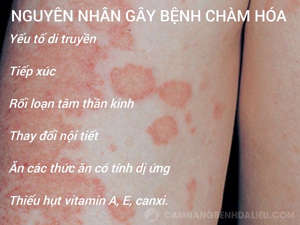tránh bệnh chàm hoá