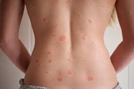 bệnh vảy nến hồng