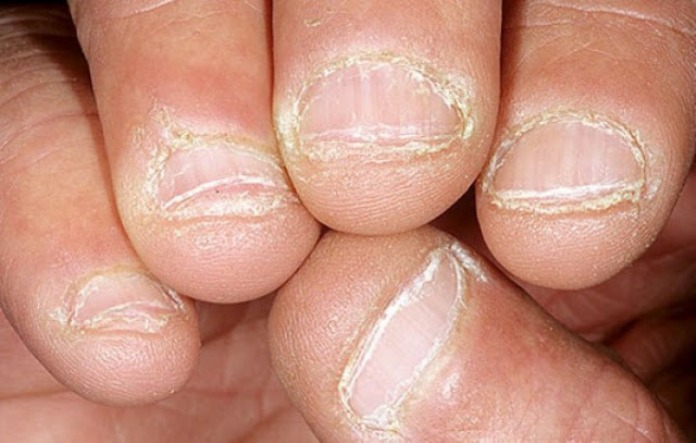 hình ảnh vảy nến móng tay