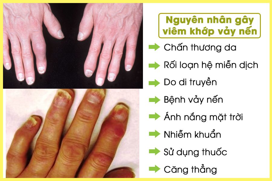 nguyên nhân viêm khớp vảy nến