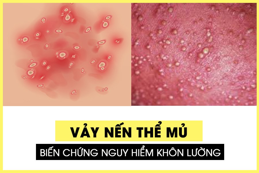 bệnh vảy nến thể mủ