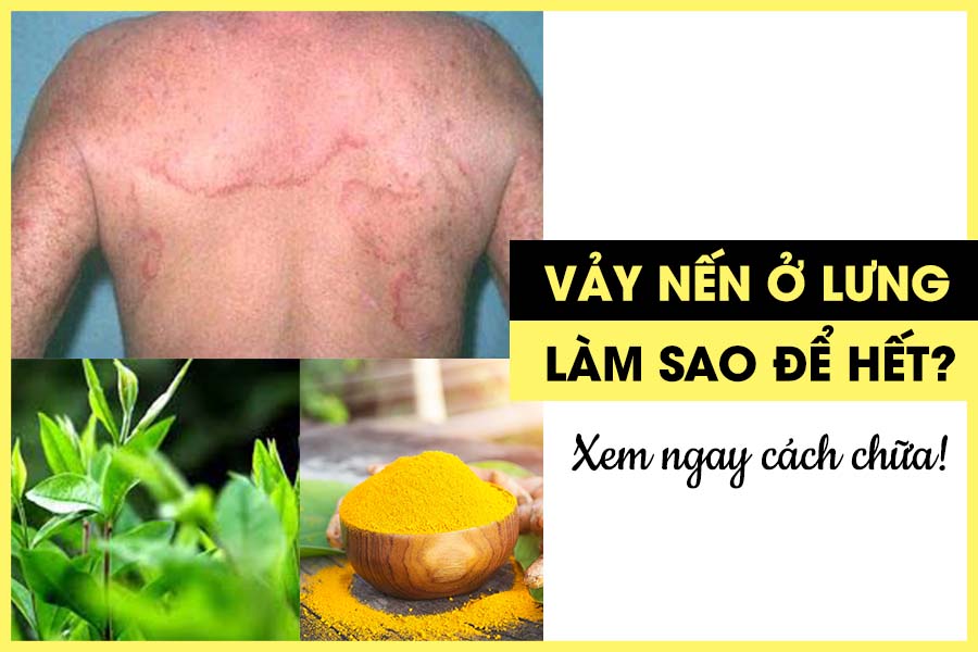 cách chữa vảy nến ở lưng